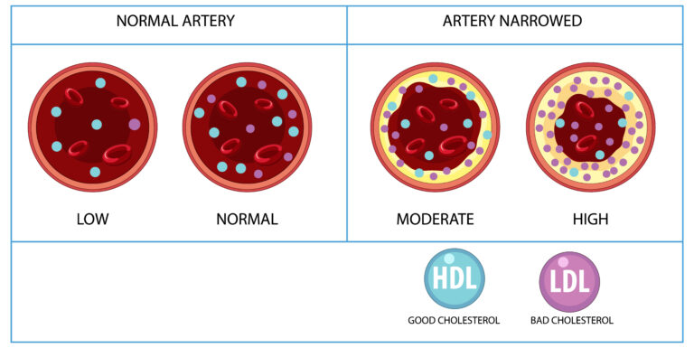 lipid disorders