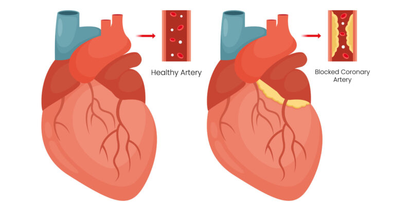 Caronary artery disease